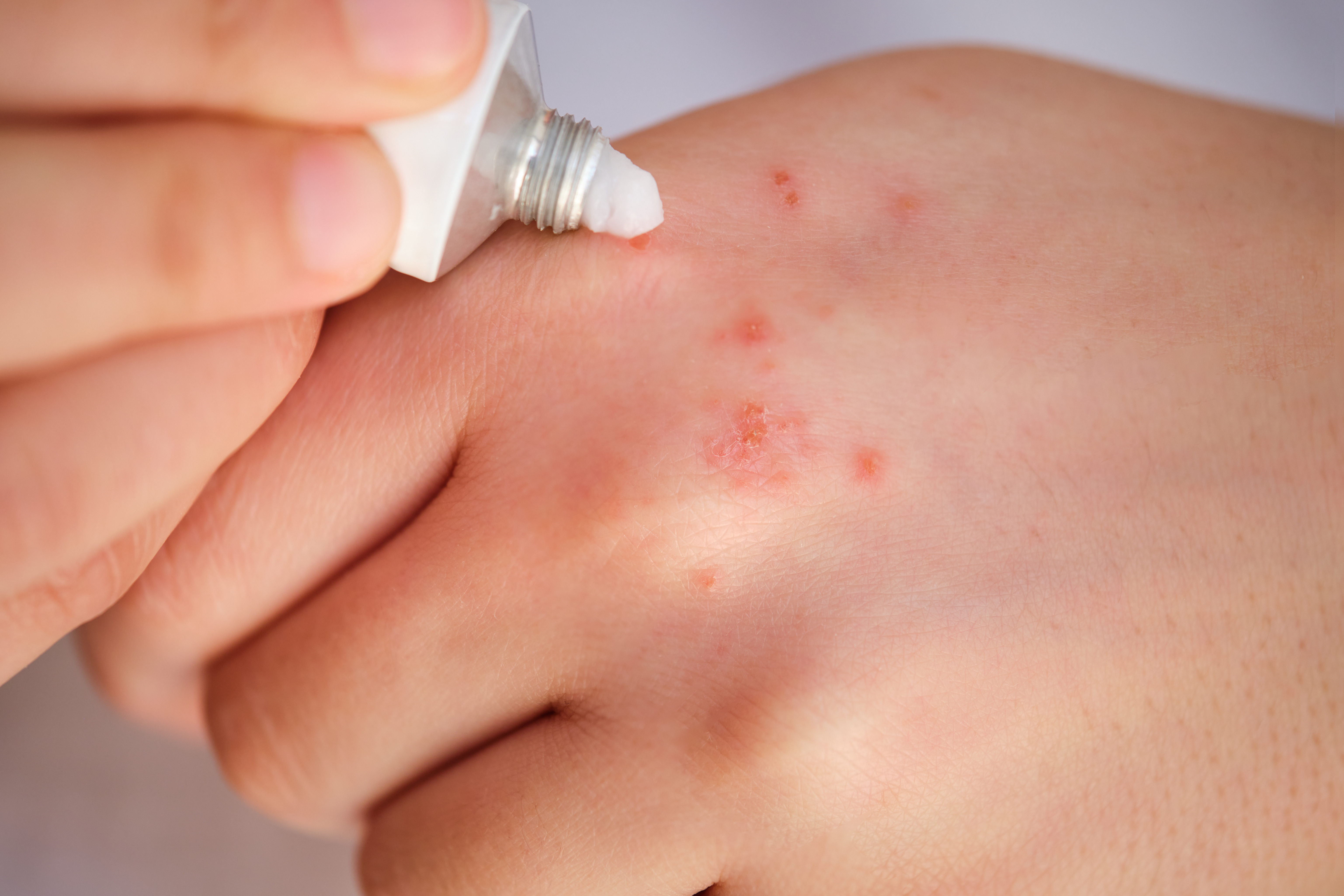 Derma